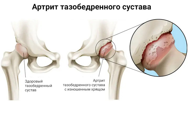 Как выглядит артрит тазобедренного сустава